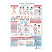 Остановка кровотечения, плакат глянцевый А1+/А2+