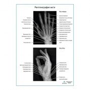Рентгенография кисти плакат глянцевый  А1/А2