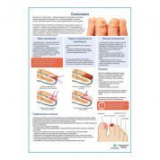 Онихомикоз медицинский плакат А1/A2