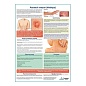 Розовый лишай (Жибера) медицинский плакат А1/A2