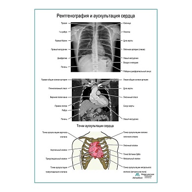 Рентгенография и аускультация сердца плакат глянцевый  А1/А2