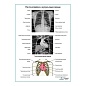 Рентгенография и аускультация сердца плакат глянцевый  А1/А2