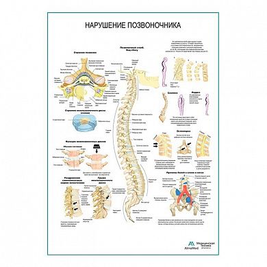 Нарушения позвоночника плакат глянцевый А1/А2