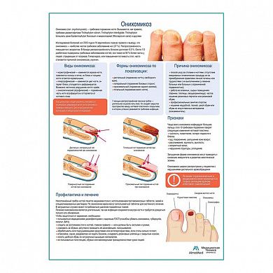 Онихомикоз медицинский плакат А1/A2