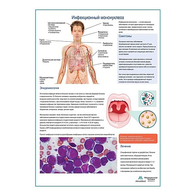 Инфекционный мононуклеоз медицинский плакат А1/A2