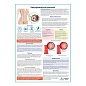 Бактериальный вагиноз медицинский плакат А1/A2