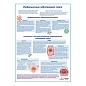 Инфекционные заболевания горла медицинский плакат А1/A2