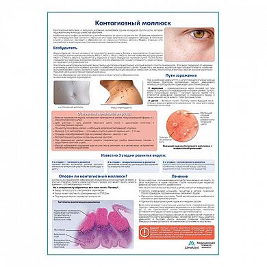 Контагиозный моллюск медицинский плакат А1/A2