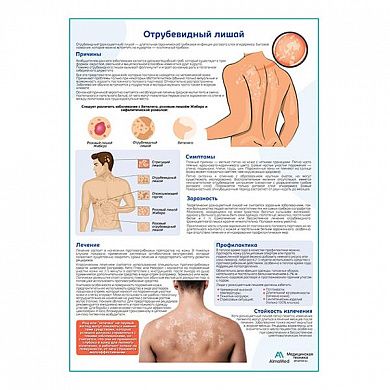 Отрубевидный лишай медицинский плакат А1/A2
