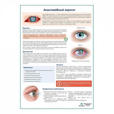 Акантамёбный кератит медицинский плакат А1/А2