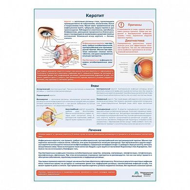 Кератит медицинский плакат А1/A2